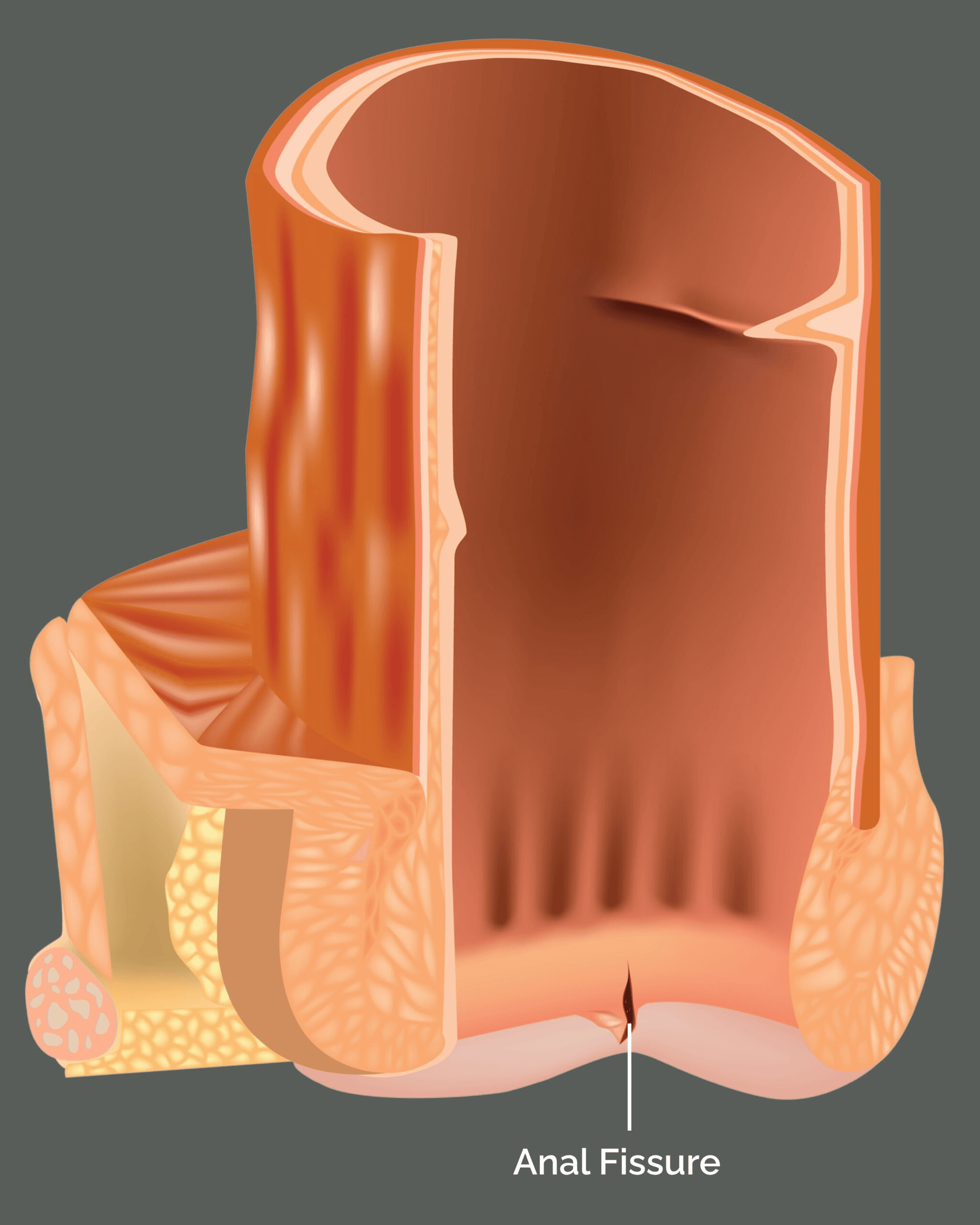 Understanding anal fissure