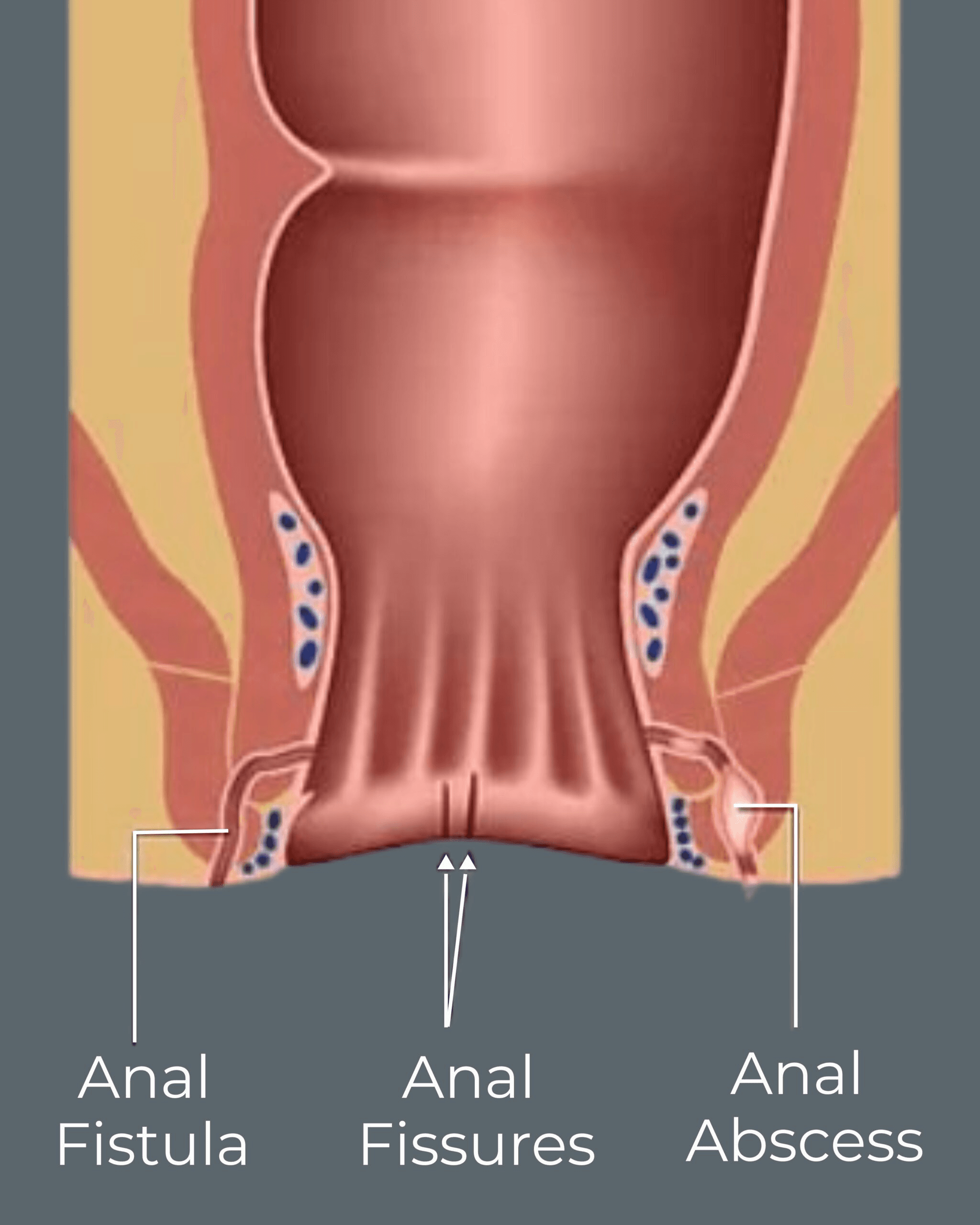 Understanding anal fistula