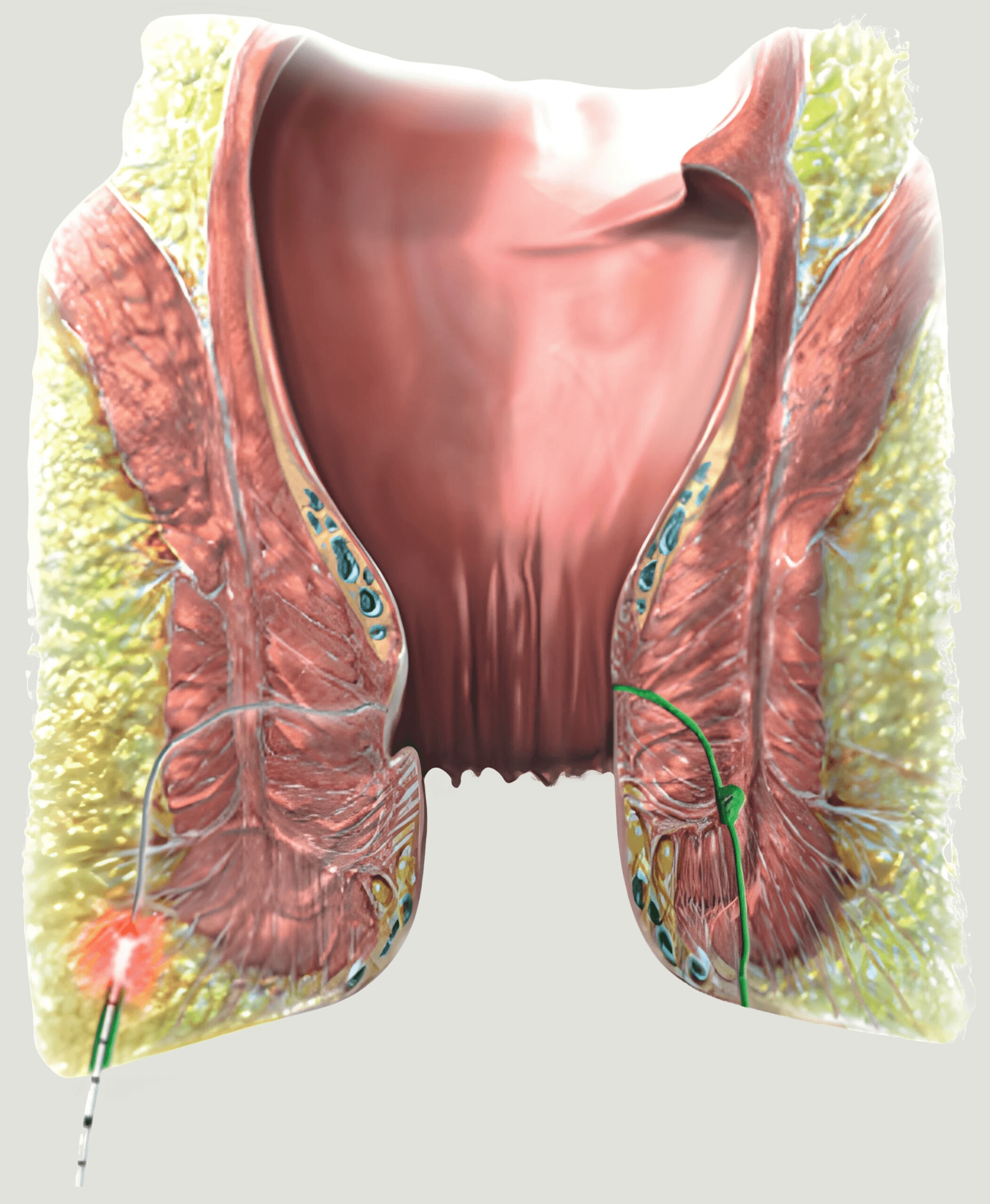 FiLaC® — Laser Fistula Closure