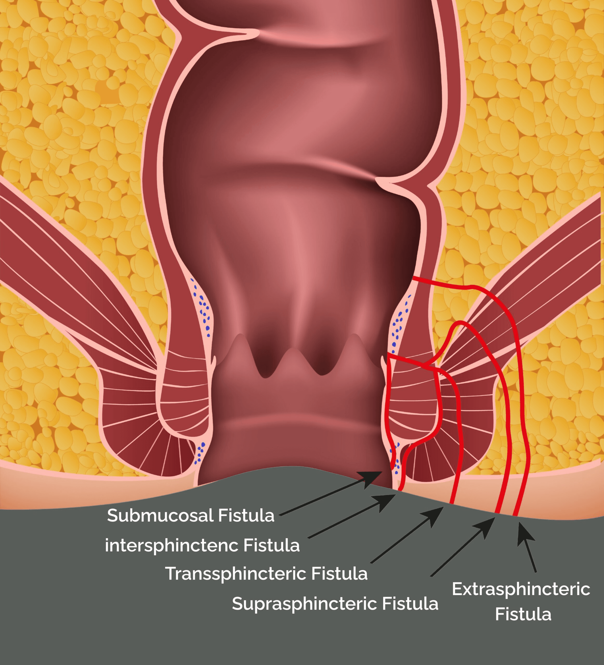 Types of anal fistula