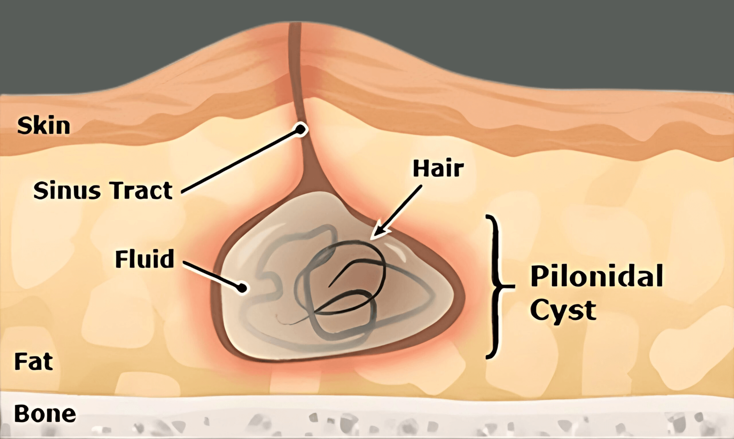 Understanding pilonidal sinus